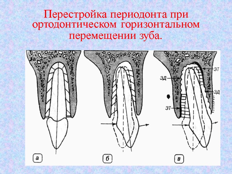 Перестройка периодонта при ортодонтическом горизонтальном  перемещении зуба.